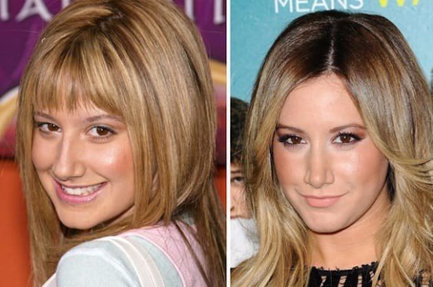 rhinoplasty