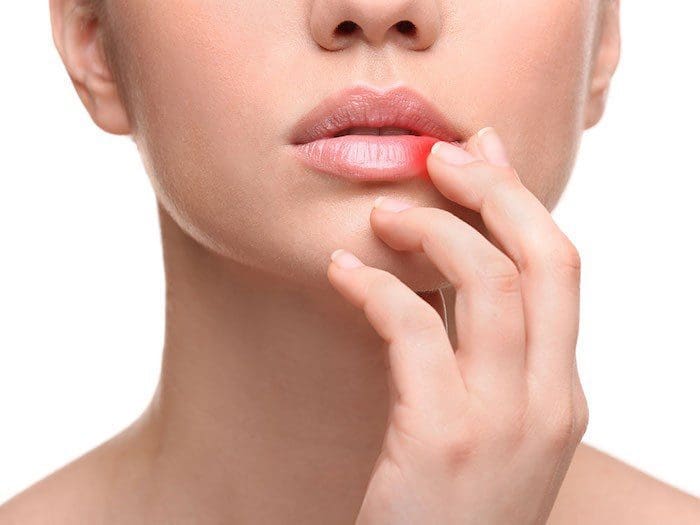 Lip Sore