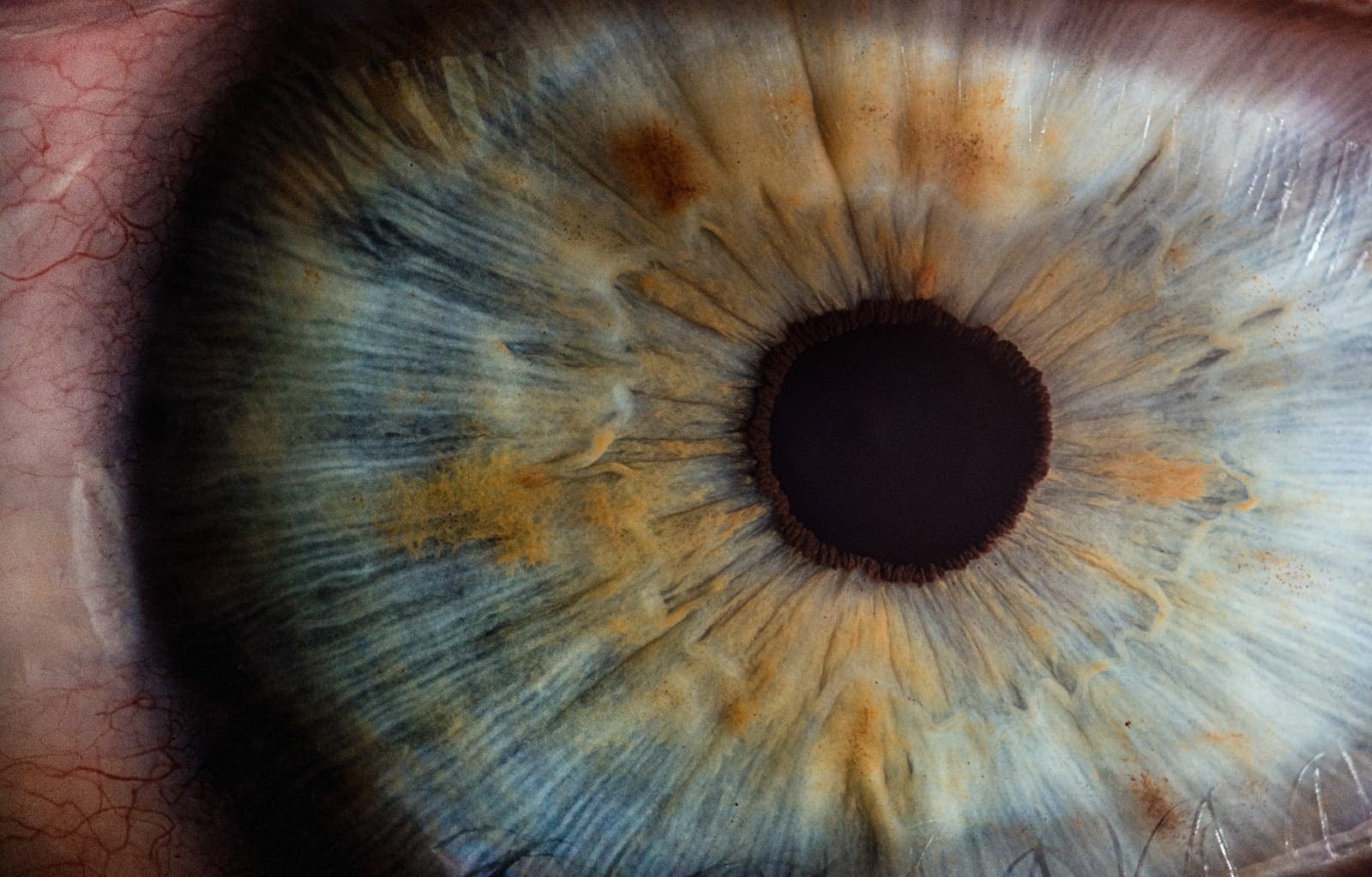 Cataract surgeries