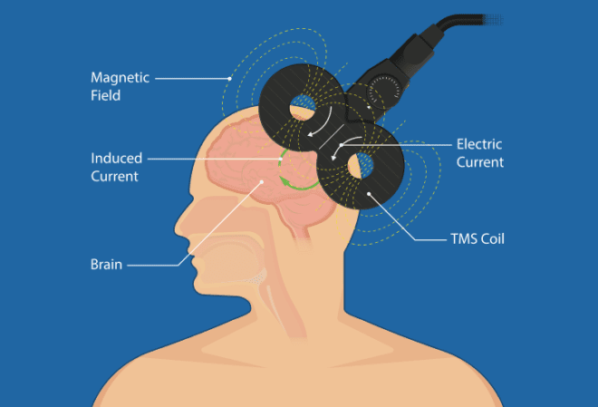 tms for treating depression